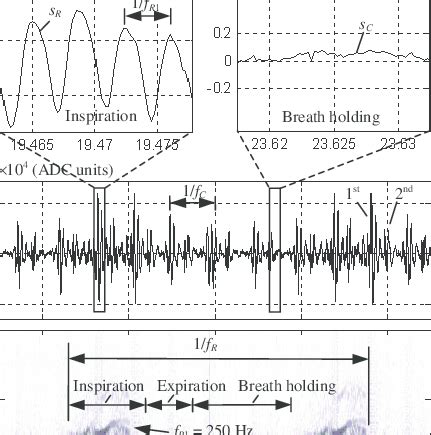 Vesicular lung sounds during normal breathing. (a) Sensor signal s ...