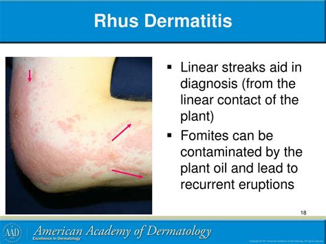 PPT - Contact Dermatitis PowerPoint Presentation, free download - ID:4929796