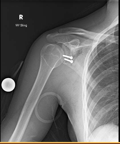 Latarjet Procedure | Shoulder Instability | Shoulder Surgeon