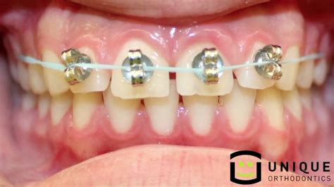 DIY braces are a thing -- but not a good one - ABC13 Houston