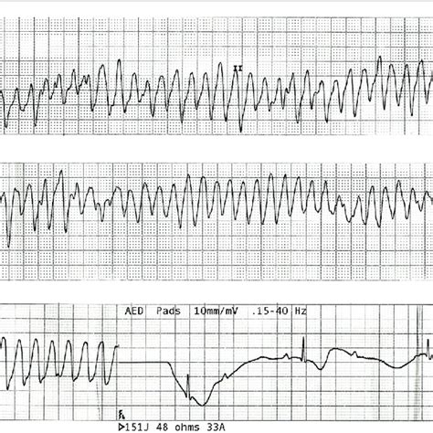 Ventricular Flutter Vs Torsades | The Best Porn Website