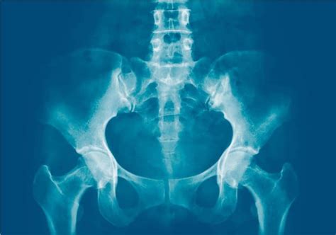 Sacroiliac Joint Dysfunction X Ray