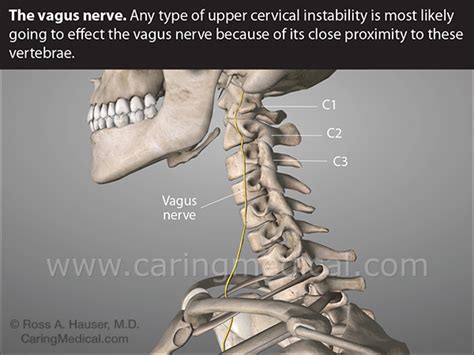 Cervical spine problems, Vagus nerve compression, urinary incontinence ...