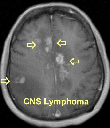 Brain (CNS) Lymphoma