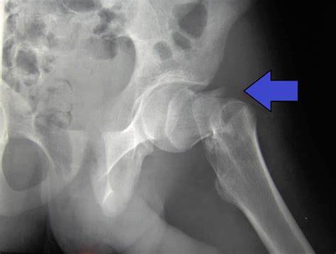 Hip Fracture (Neck of Femur / NOF) - almostadoctor