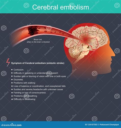 Cerebral Embolism. Infographic Illustration. Anatomical Human and ...