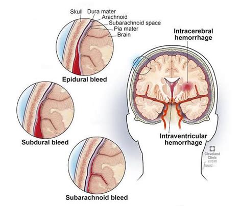 Epidural hematoma - MEDizzy