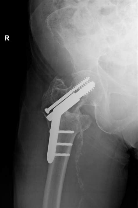 Dynamic Hip Screw - DHS - Physiopedia