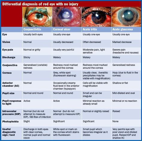 PLAB king: Acute Red Eye (807/1700)