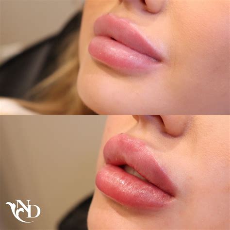 Pin on Lip Filler Before/Afters