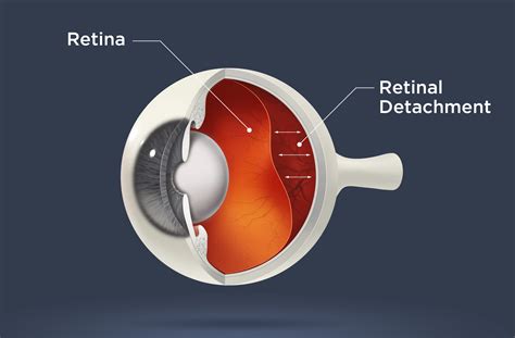 What is Retinal Detachment | Causes, Symptoms & Treatments