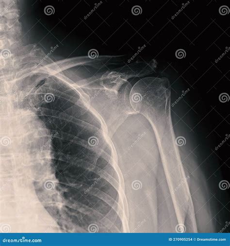 X-ray Shoulder Joint Shoulder Front View for Diagnosis Fracture of ...