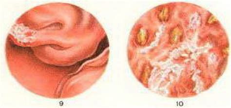 cystitis_chronic | Bizimtebib.az