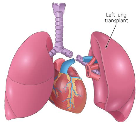 Heart Lung Transplant