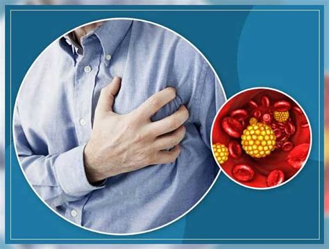 High Triglycerides: Risks, Causes, and Treatment - REPC