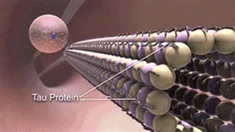 Higher Levels of Alzheimer's Protein in Under 18's With Early Onset Psychosis - Neuroscience News