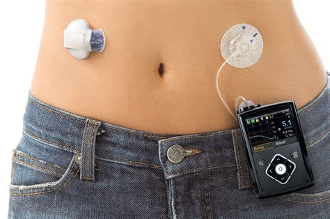 Artificial Pancreas for Diabetics Seeks FDA Approval - Newsweek