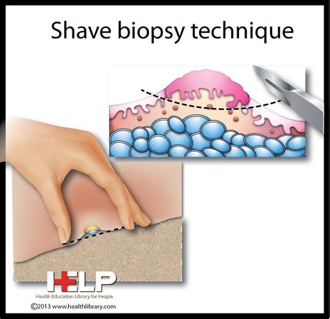 Shave Biopsy Technique - here we go again! | Shaving, Skin, Techniques