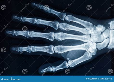 Human Adult Right Hand Bones X-ray Image. Medical and Anatomy ...