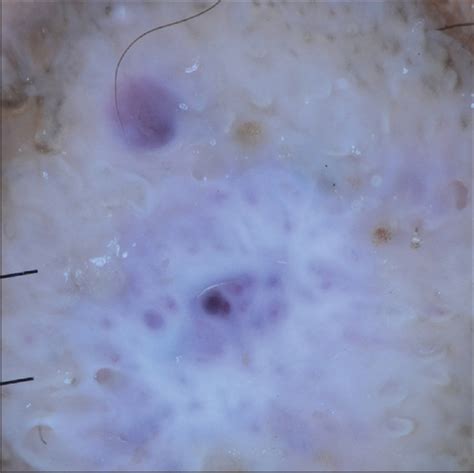 Wickham's striae-like appearance in a case of nodular Kaposi's sarcoma ...