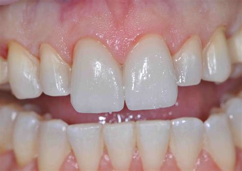 Anterior Veneer Try-In - Lee Ann Brady DMD