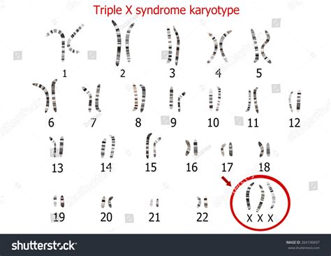 29 imagens de Syndrome triple x Imagens, fotos stock e vetores ...