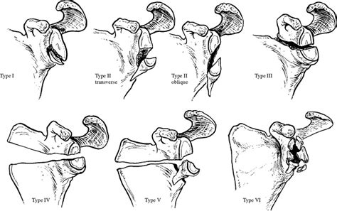 Scapula Fractures | Musculoskeletal Key