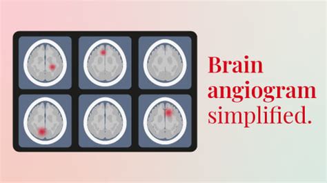 All about Cerebral Angiography or Brain Angiogram Procedure - Rela Hospital