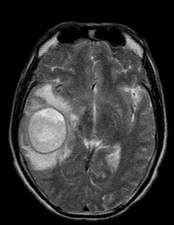 Brain Abscess-MRI - Sumer's Radiology Blog