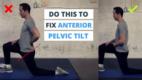 6 Minute Routine to Correct ANTERIOR Pelvic Tilt - YouTube