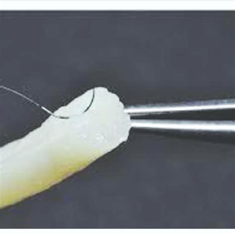 Avance Nerve Graft. | Download Scientific Diagram