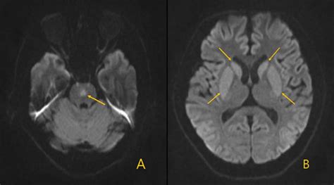 Central pontine myelinolysis, causes, symptoms, diagnosis, treatment & prognosis