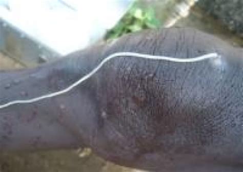 New Guinea Worm Case Confirmed in Ethiopia | WHO | Regional Office for Africa