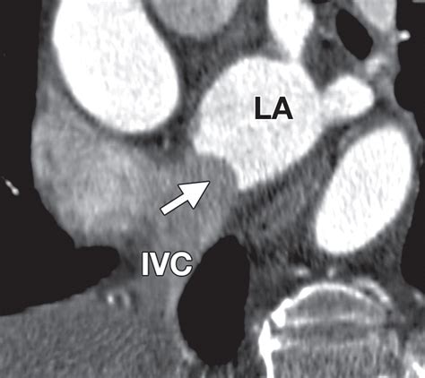 Paradoxical Embolism: Role of Imaging in Diagnosis and Treatment Planning | RadioGraphics