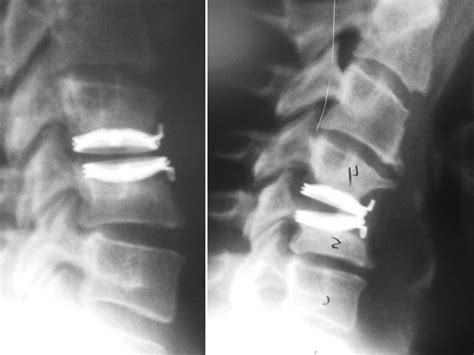 Posts tagged "cervical-spine" - Neurosurgery Blog