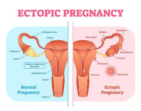 Ectopic or tubal pregnancy Causes, Symptoms & Treatment -Clicks Health Hub