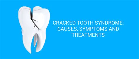 Cracked Tooth Syndrome | Teeth Clenching | Root Canal Therapy | Dr ...