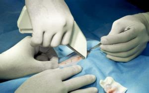 Recent Finding Reveals Over 50k Surgical Stapler Complications Were Reported to a Hidden FDA ...