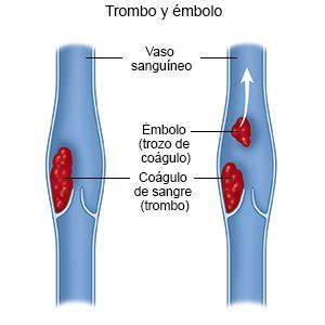 Trombosis Venosa Profunda Care Guide Information En Espanol