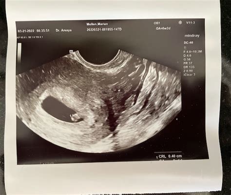 What Does A Miscarriage Ultrasound Look Like at melissadfpowell blog