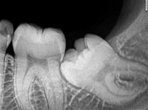 Wisdom Teeth Pain | Wisdom Tooth Symptoms | Impacted Molars & Extraction