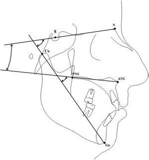 Craniofacial morphology in patients with obstructive sleep apnea: cephalometric evaluation ...