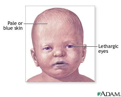 My Notes for USMLE — Gray baby syndrome = chloramphenicol toxicity ...