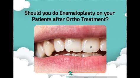 Enameloplasty or Tooth Shaping and Teeth Filing after Braces or Invisalign - YouTube