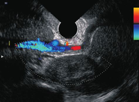 The endoscopic ultrasound from the body of the stomach shows that the ...