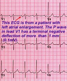 Step 5: Inspect P waves for atrial enlargement