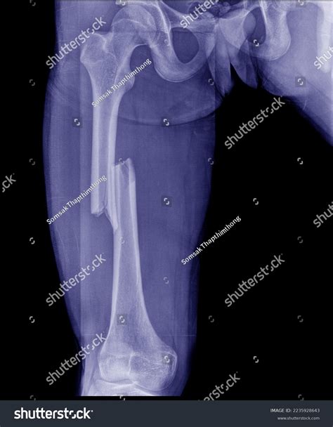 Xray Images Femur Showed Central Fracture Stock Photo 2235928643 ...