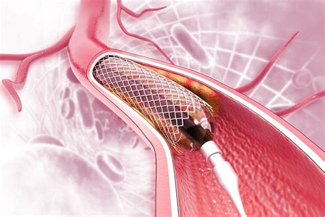 Coronary Artery Angioplasty / Stenting in El Paso, TX