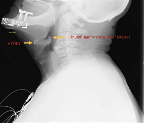 Swollen Epiglottis Treatment