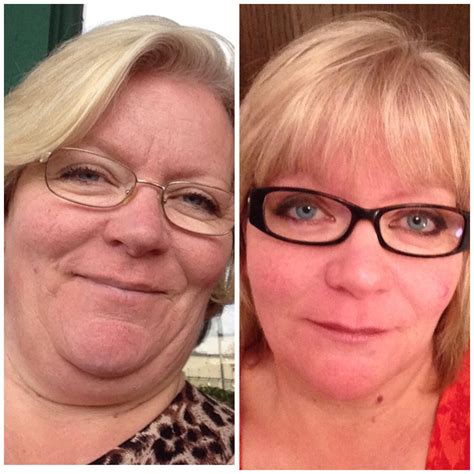 Hypothyroid in photos-Before and After - Stop The Thyroid Madness